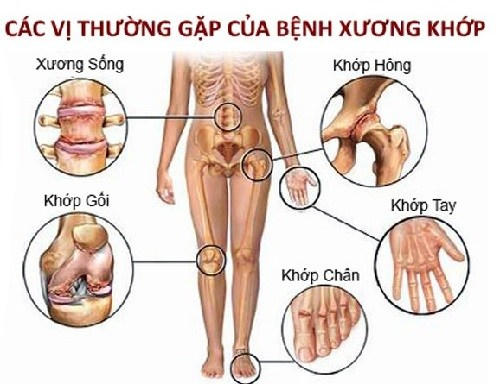 Các vị thường gặp của bệnh xương khớp