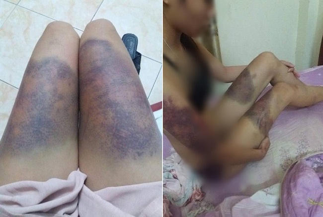 Hình ảnh cô gái mang trên mình đầy vết thương thâm tím tố bị bạn trai hành hung. (Ảnh: Facebook).