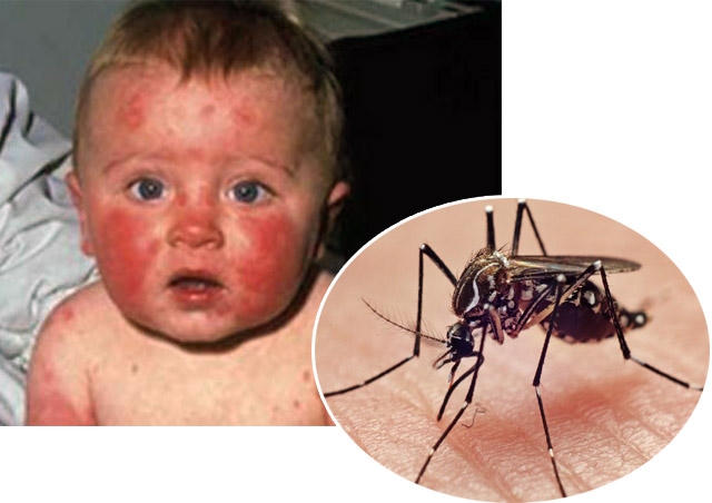 Dịch zika ngày càng phức tạp.