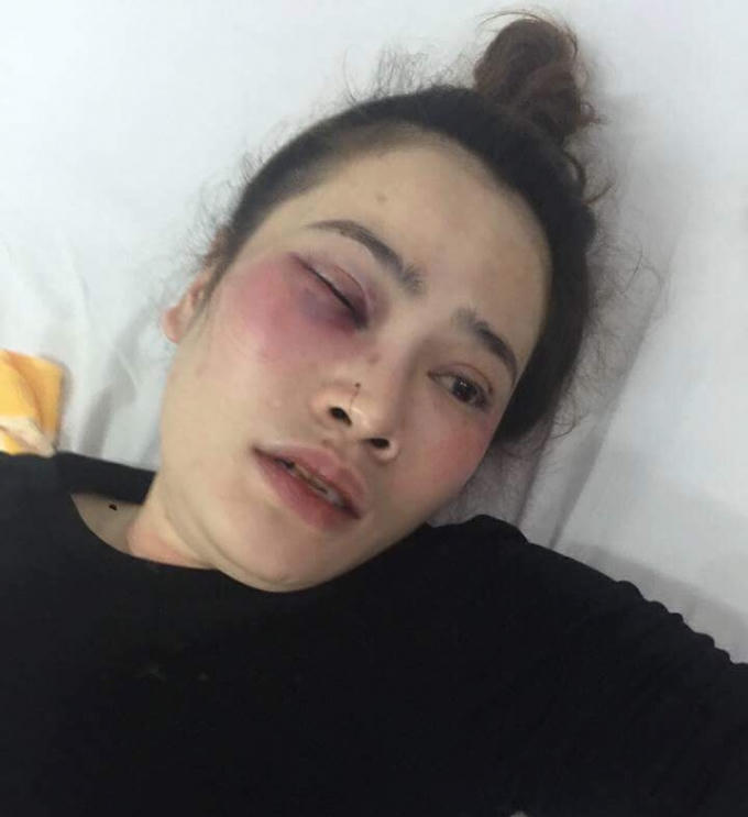 Sau khi bị tấn công, cô gái bị gãy răng và mũi; dập nhãn cầu mắt..