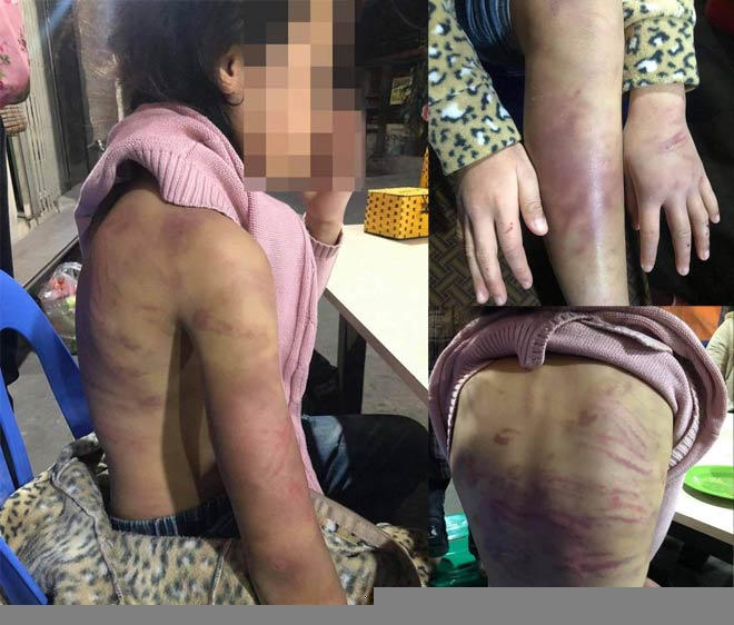 Hà Nội yêu cầu khẩn trương làm rõ vụ bé gái 12 tuổi ở Hà Đông nghi bị mẹ đẻ bạo hành dã man
