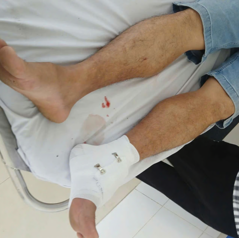 Nạn nhân bị thương ở chân do bị cá sấu cắn.
