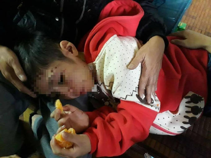 Ch&aacute;u K. với thương t&iacute;ch đầy người.