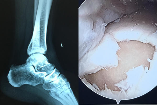 Sụn xương bị rách gây đau đớn cho bệnh nhân suốt hơn 1 năm