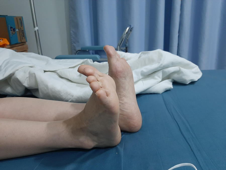 Chân trái của nữ bệnh nhân dài thêm 4cm sau khi phẫu thuật ở bệnh viên Đa khoa Quốc tế Hải Phòng.