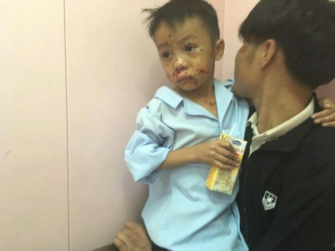 Em Trần Bảo Thạch bị thương vùng mặt và ngực vì đốt vật lạ phát nổ.