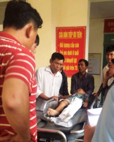 Cháu Nguyễn Đức Trần Sang bị gãy nát cẳng chân trái đang điều trị tại bệnh viện.