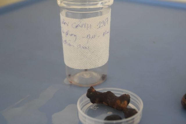 Viên sỏi san hô được các bác sĩ phẫu thuật lấy khỏi thận bệnh nhân.