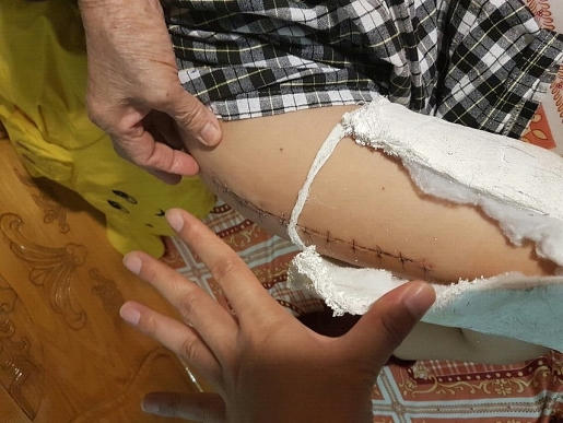 Hiện cháu Kiên vẫn chưa thể đi lại bình thường và phải nghỉ học ở nhà hơn hai tháng nay để điều trị (Ảnh: Chí Dũng).