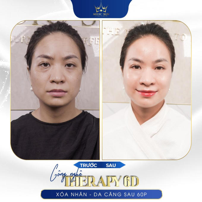 Hình trước và sau khi trẻ hóa của khách hàng thực tế tại Medic Skin.