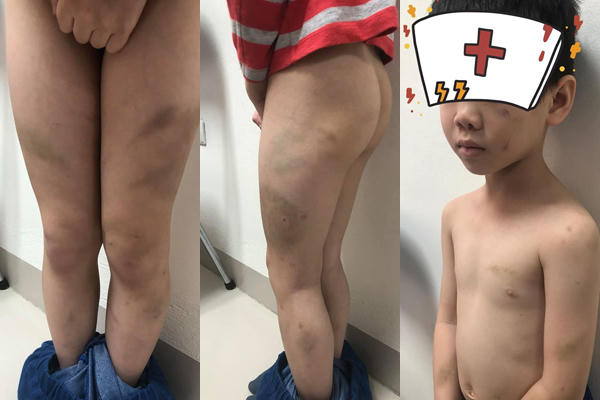 Cháu bé với những vết bầm tím khắp người