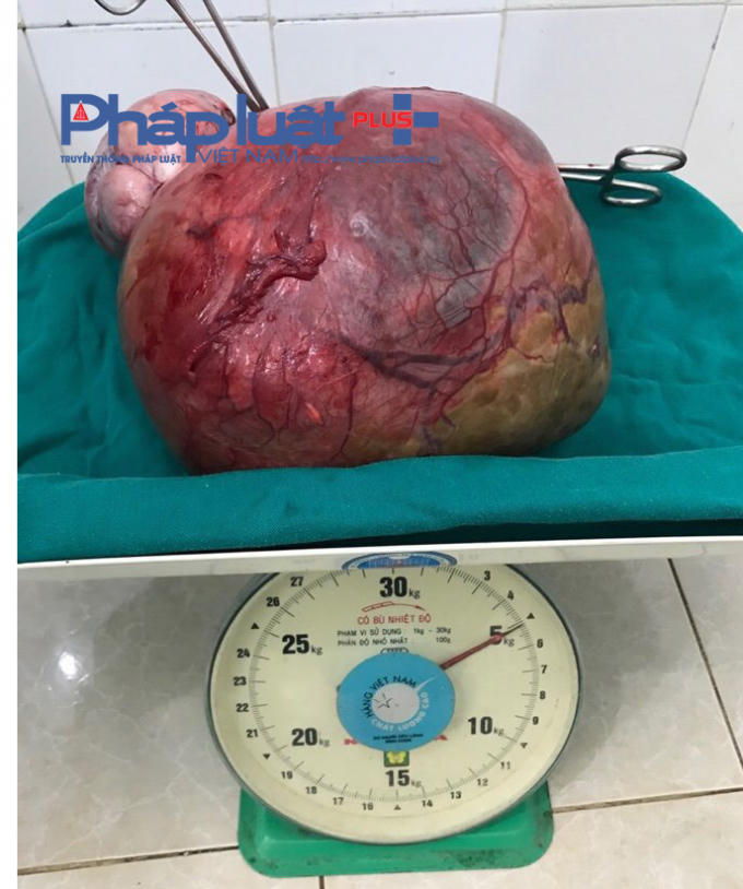 U nang nặng 5kg do các bác sĩ Bệnh viện đa khoa huyện Đồng Văn phẫu thuật.