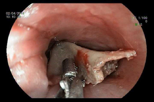 Khúc xương gà đóng ngang thực quản khiến bệnh nhi đối ặt với nhiều nguy hiểm