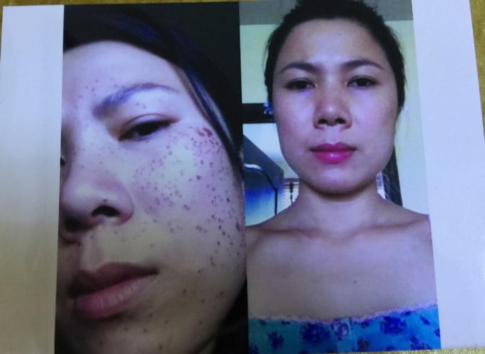 Khách hàng điều trị nám tại spa Ngọc Tú.