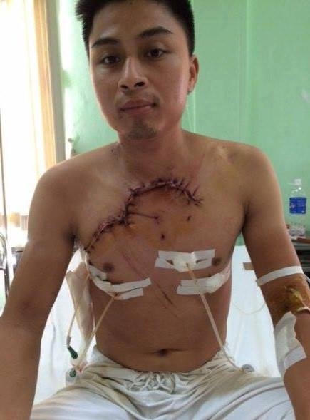 Bệnh nhân Đoàn Hữu Đ được các bác sĩ BV Việt Đức cứu sống sau 4 tiếng phẫu thuật và đang dần hồi phục. (ảnh. BVCC)