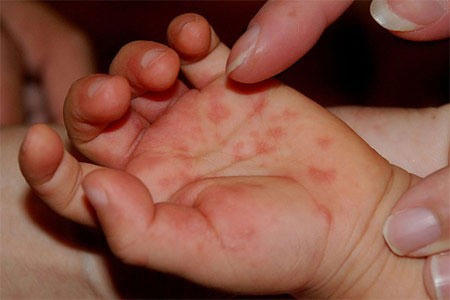 Bệnh tay ch&acirc;n miệng v&agrave;o m&ugrave;a: 8 c&acirc;u hỏi mẹ n&agrave;o cũng cần biết