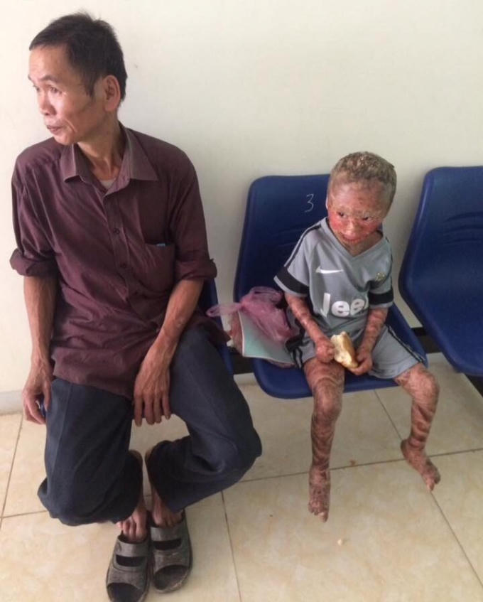 Cháu Q. được ông Nội đưa tới Bệnh viên khám.