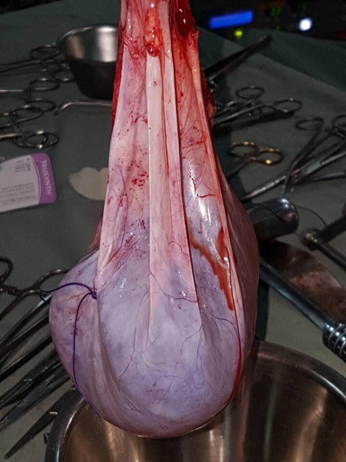 Khối u có trọng lượng lên đến 6 kg được các bác sĩ cắt bỏ ra khỏi ổ bụng của cụ bà 102 tuối.