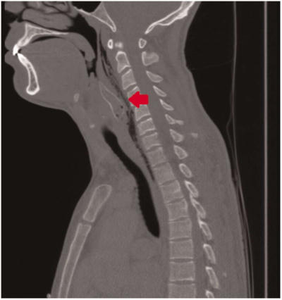 Thử thách uống bia nuốt cá sống khiến chàng trai suýt chết