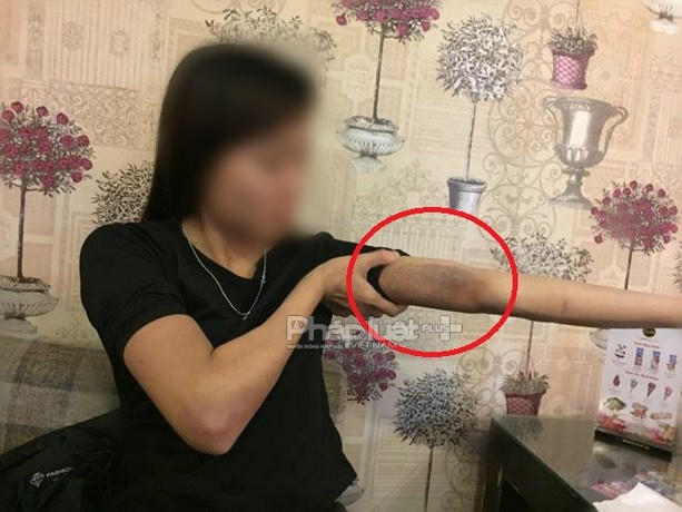 Sau nhiều ngày từ khi bị hành hung, những vết thâm tím trên cơ thể chị H. vẫn còn rõ.