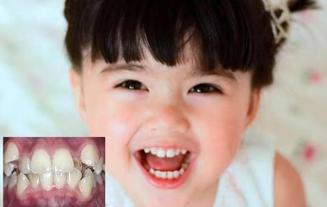 Hàm răng không đẹp khiến nhều bé kém tự tin và ảnh hưởng đến khả năng nhai và cắn.