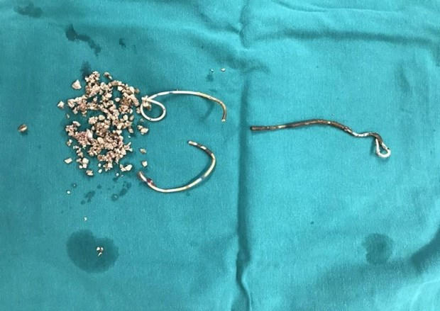Rất nhiều viên sỏi và stent bị gãy làm ba đoạn. (Ảnh: PV/Vietnam+)