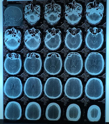 Hình ảnh phim chụp não của bệnh nhân bị ngộ độc methanol nặng. Ảnh: Đỗ Hằng