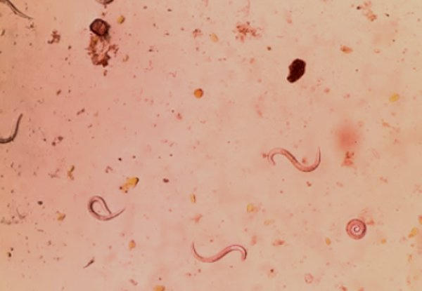 Trong cơ thể người, ấu trùng giun lươn nở thành lươn và lớn dần, có thể tồn tại nhiều chục năm.