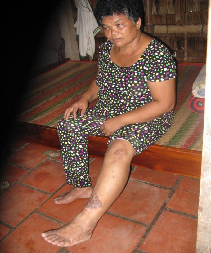 Những dấu bệnh vẫn còn trên chân, tay bà Cốt.