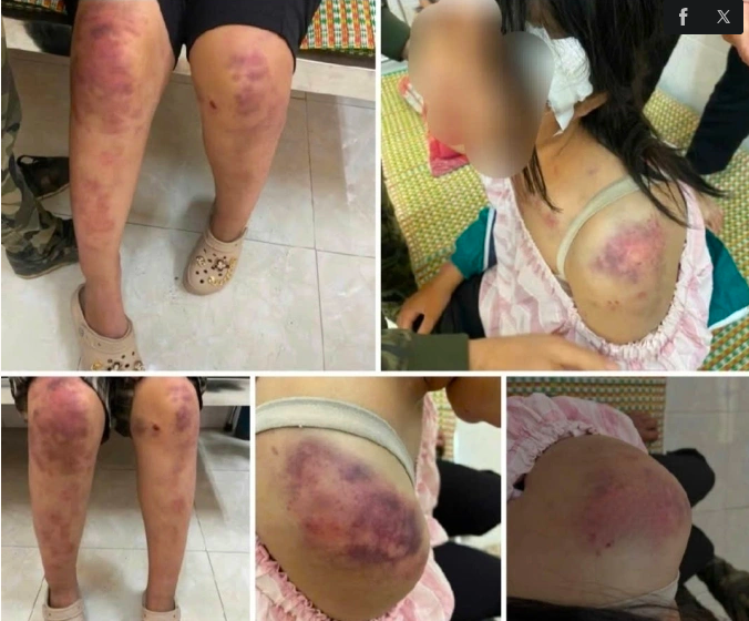 Bé gái bị thương tích khắp người. Ảnh: Quỳnh Trang