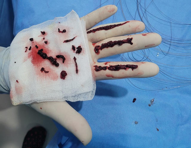 Một bệnh nhân bị đột quỵ may mắn được các bác sĩ can thiệp kịp thời, lấy máu đông tái thông mạch máu