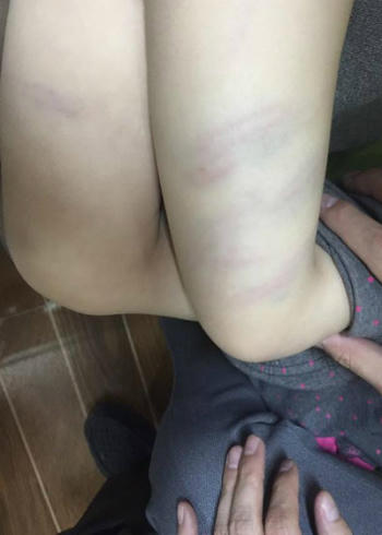 Bé gái bị đánh bầm tím khắp hai bắp đùi. Ảnh: Lê Hoàng.