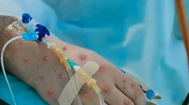 Hà Nội: Sẽ điều tra dịch tễ nếu có ca dương tính với đậu mùa khỉ