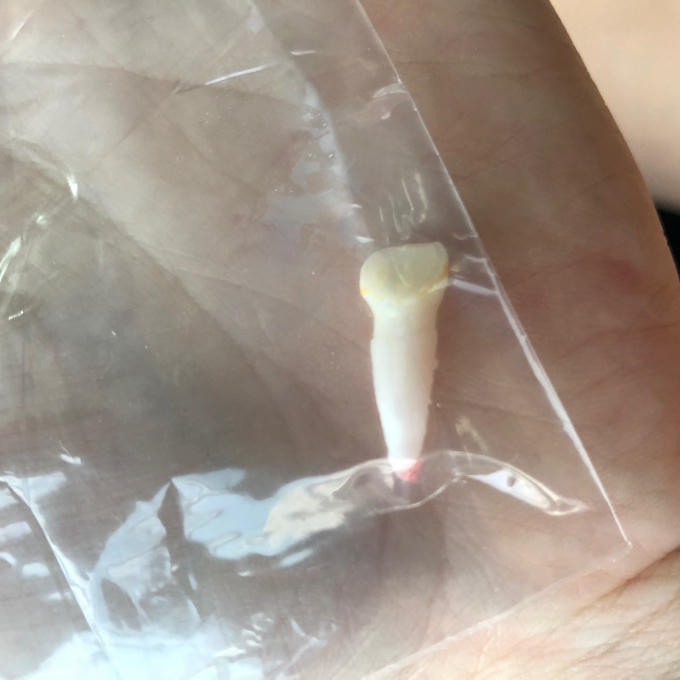 Chiếc răng đựng trong túi nilon được cô giáo trường BVIS đưa cho gia đình.