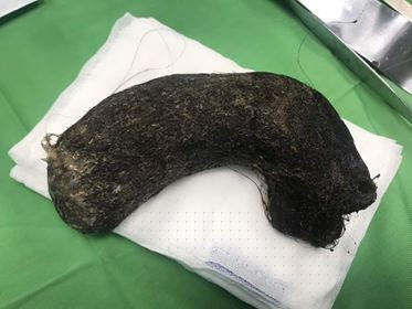 Hình ảnh búi tóc nặng 1kg lấy từ dạ dày bệnh nhân 11 tuổi.