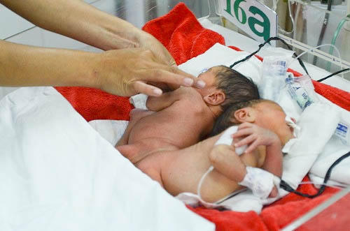 Hiện tại hai bé nằm lồng ấp, truyền dịch để nuôi ăn tĩnh mạch toàn phần, ăn sữa tối thiểu để thăm dò tiêu hóa sữa và lưu thông đường tiêu hoá.