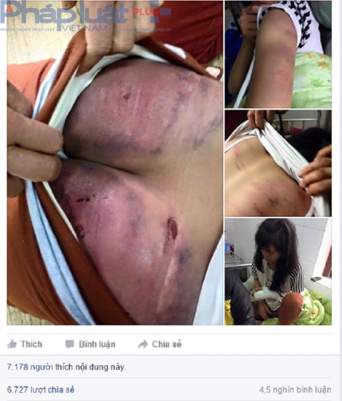 Hình ảnh bé gái bị cha đánh bầm dập, thâm tím, gãy tay. Nguồn: Facebook