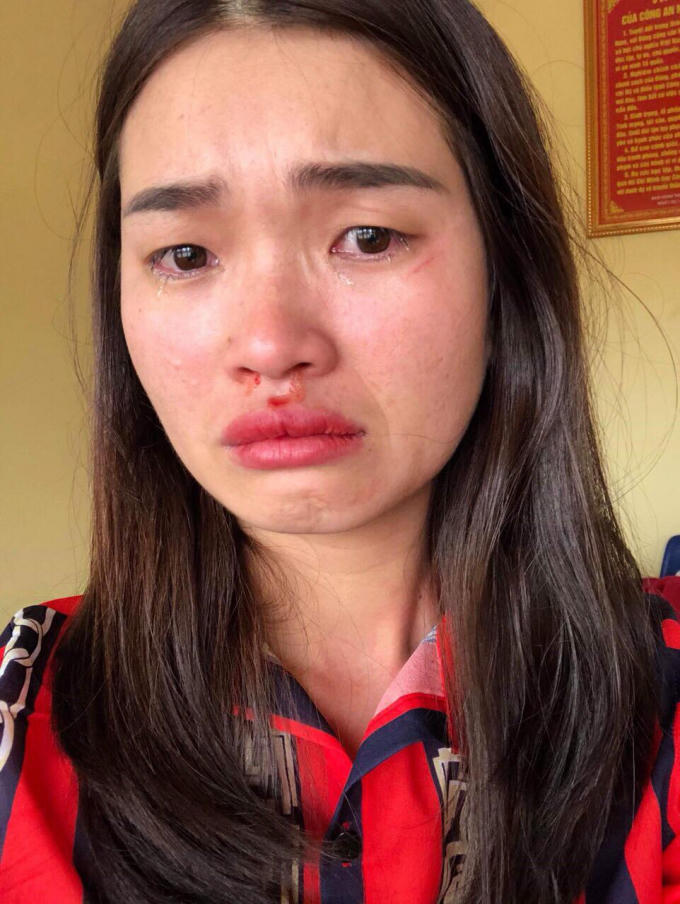 Chị Hoài với những vết thương sau khi bị hành hung (ảnh nạn nhân cung cấp).