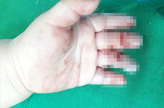 Bàn tay bé T.A tổn thương nặng nề sau khi bị máy xay cá cuốn vào (ảnh BV Sản Nhi Nghệ An)