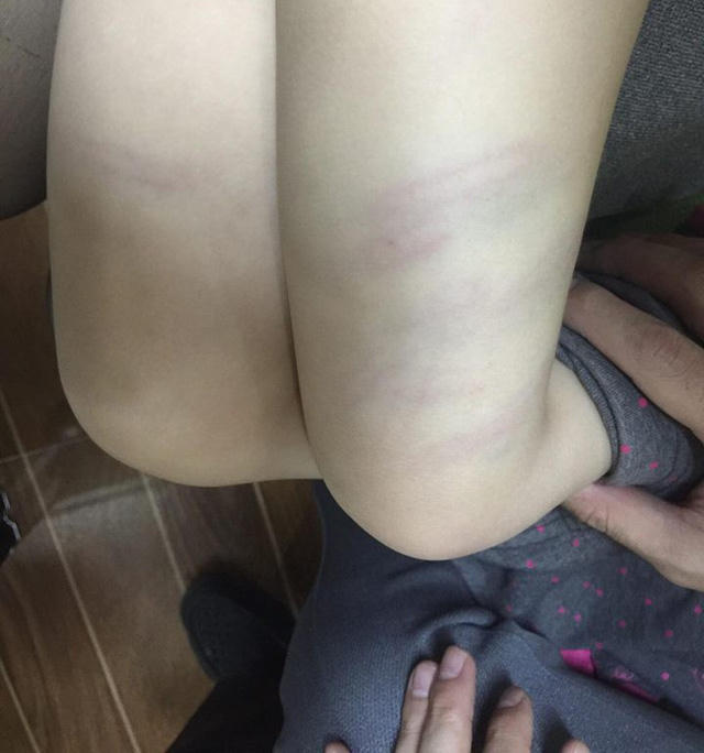 Những vết bầm tím trên đùi cháu Phương do cô giáo Linh đánh.