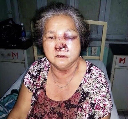 Bà Hoàng bị đánh bầm dập mặt mũi.