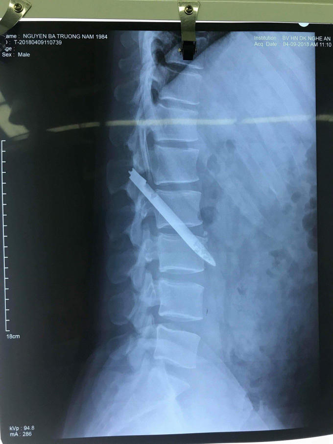 Hình ảnh chụp Xquang cho thấy lưỡi dao dài nằm trong cơ thể bệnh nhân khiến nhiều bác sĩ giật mình khi xem.