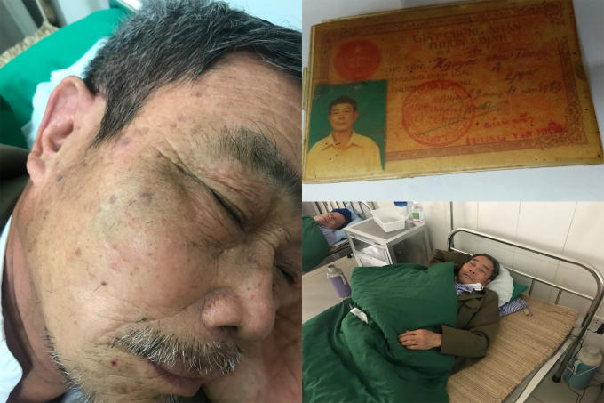 Thương tích trên mặt ông Thông (Thương binh chống Mỹ hạng 4/4) sau khi bị ông Đại hành hung và đã được điều trị tại BVĐK huyện Mê Linh.