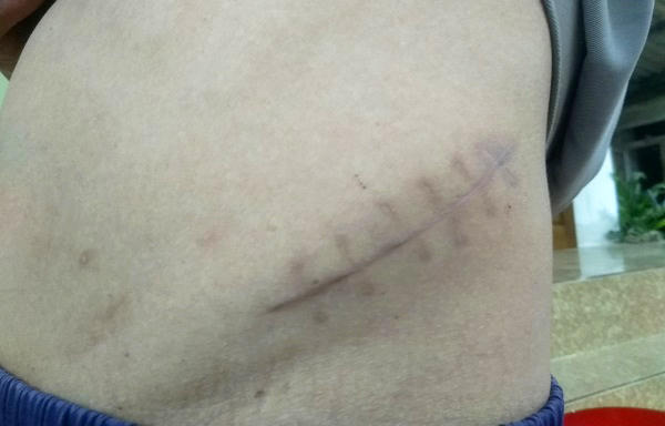 H&agrave; Tĩnh: Mổ 2 lần, bệnh viện t&iacute;nh 1 để giảm chi ph&iacute; ra viện?