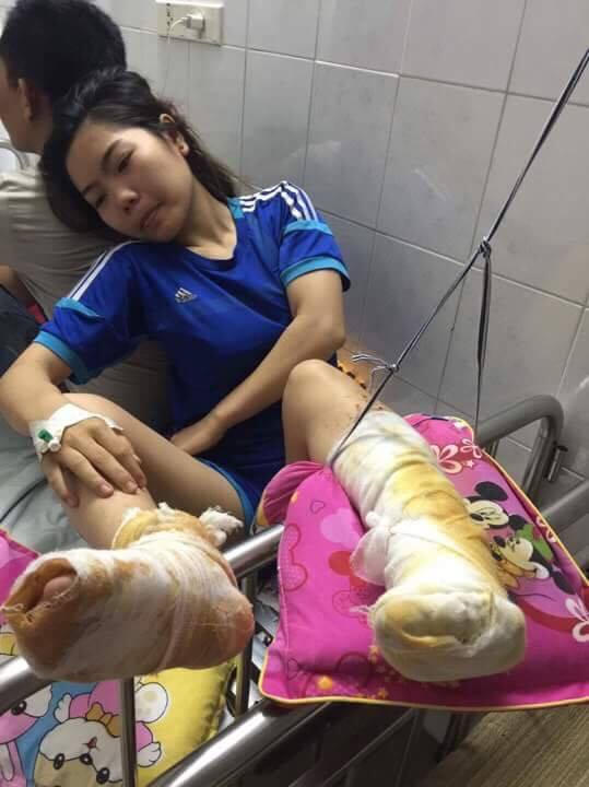 Nạn nhân Trần Thị Mai Hiên (cô ruột của hai cháu) bị bỏng nặng 2 chân sau khi ngã vào đống rác đang âm ỉ cháy.