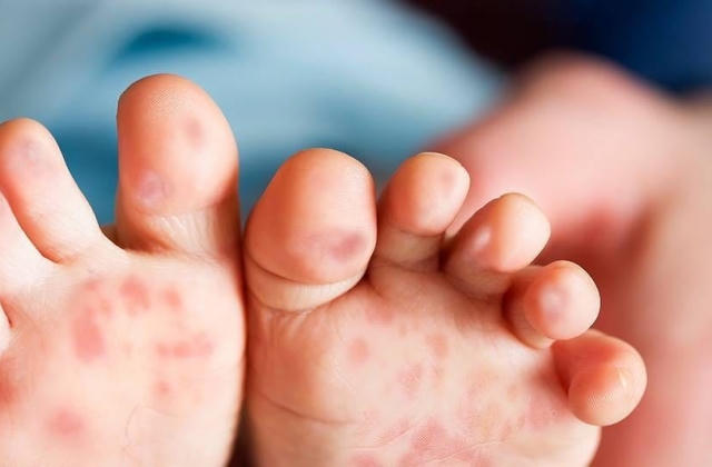 Các giải pháp phòng, chống bệnh tay chân miệng