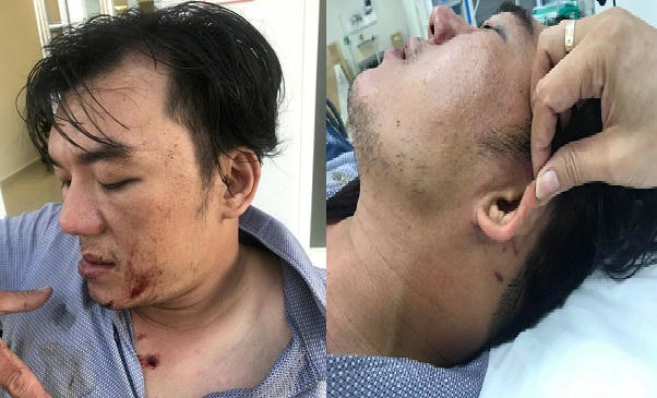 Anh Hiếu bị chấn thương não, lệch xương bàn tay, đa chấn thương vùng mặt, chấn thương vùng mang tai…
