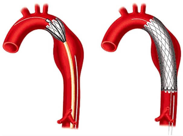 Hình ảnh mô phỏng stent đặt trong động mạch phình, nhằm giảm áp lực cho động mạch. Ảnh IT.