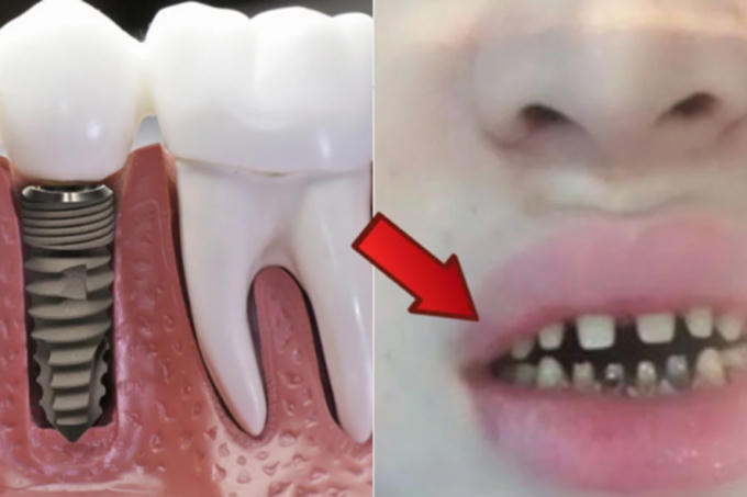 Làm răng sứ không đảm bảo: tiền mất, tật mang. Hình ảnh nạn nhân tố cơ sở làm đẹp trên mạng.