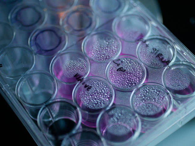 Những hiểu lầm thường gặp về nguy&ecirc;n nh&acirc;n ung thư